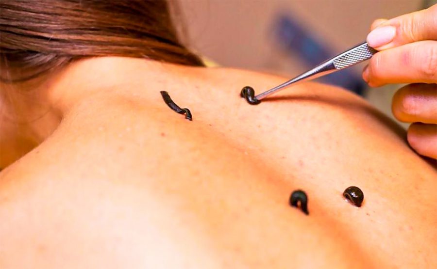 Гирудотерапия в санатории Крепость в городе Кисловодске - фотография